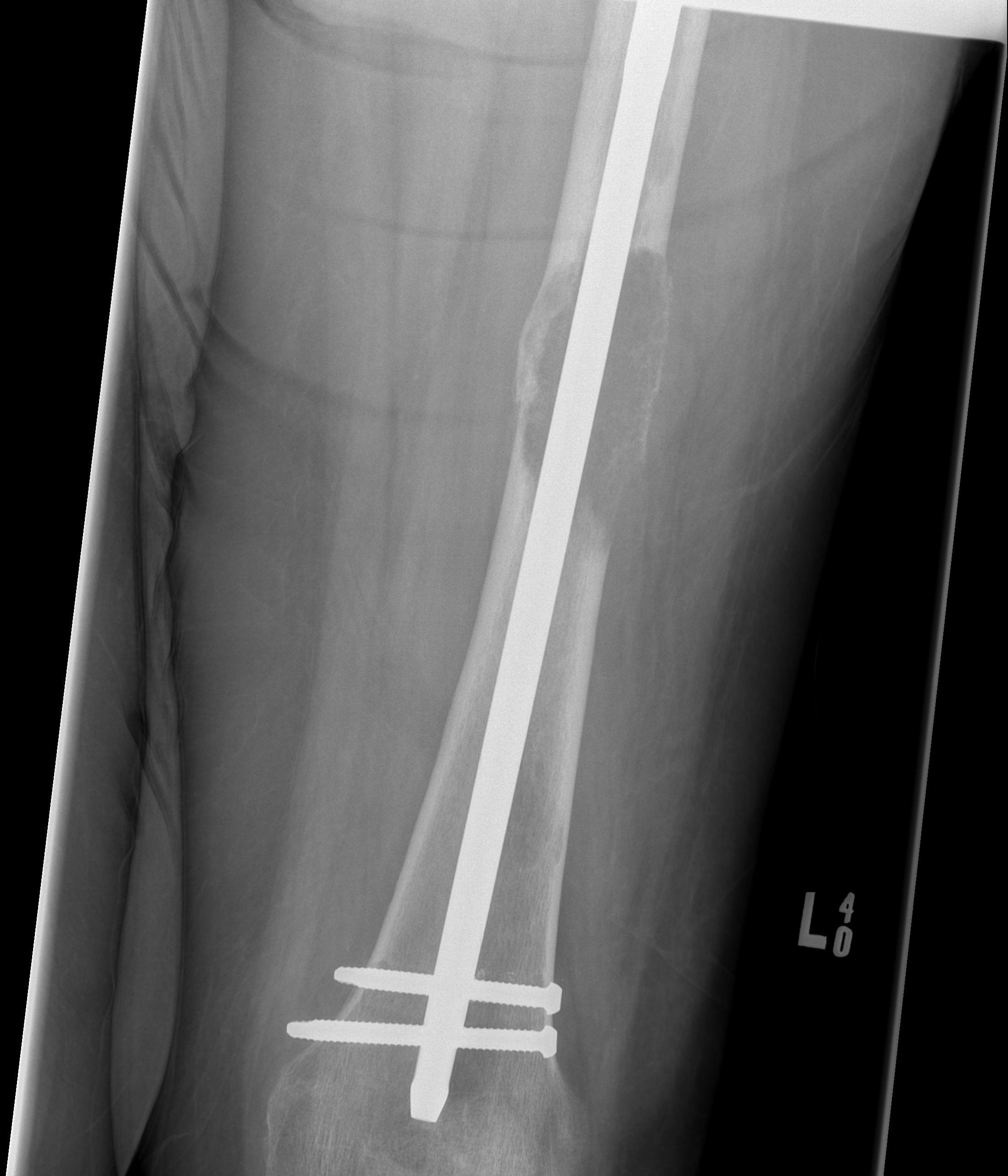 Metastasis Femoral Shaft0001